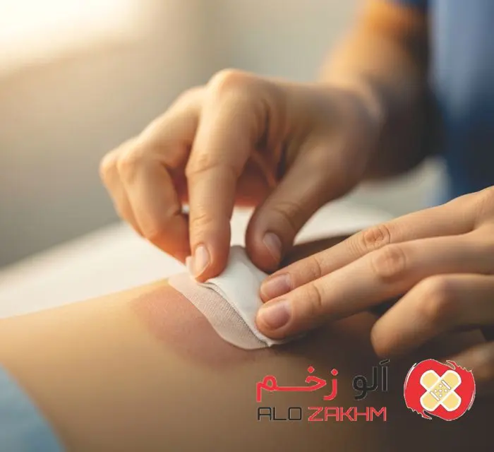 ترمیم زخم سوختگی