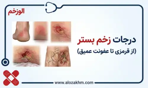 درجات زخم بستر (از قرمزی تا عفونت عمیق)